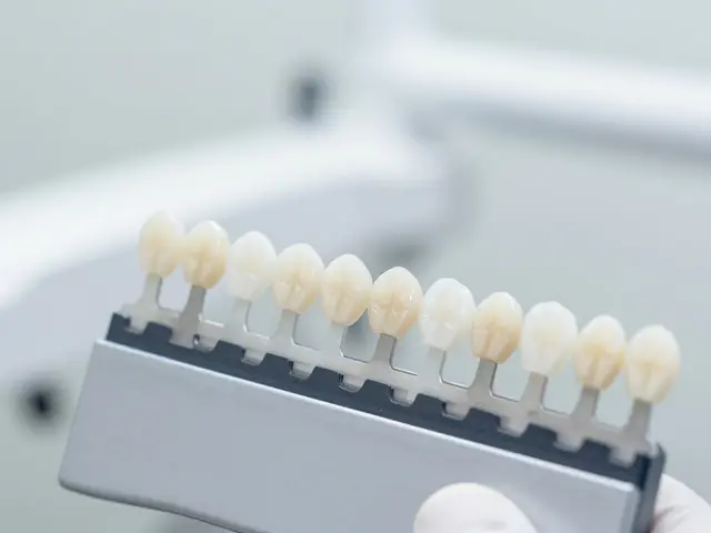 Jak se dělají kompozitní fazety? Postup, cena a výhody