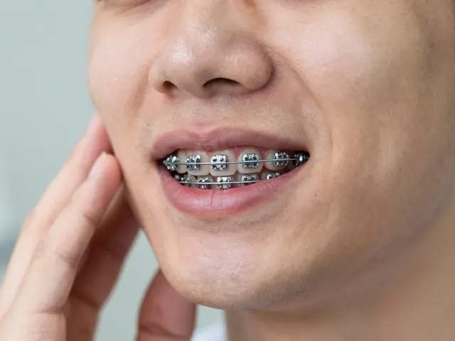 Kdy přestanou bolet rovnátka? Kompletní průvodce bolestí po nasazení a úpravách